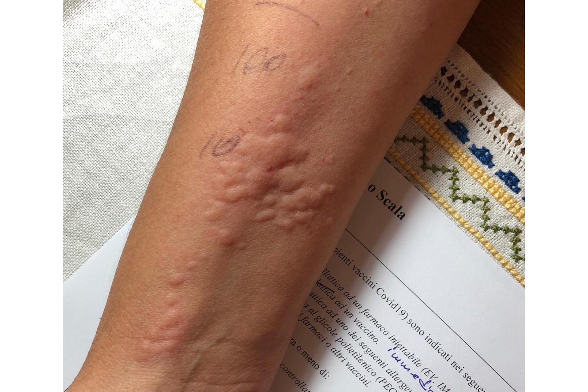 il test per l'allergia al vaccino Covid19. Chi deve farlo? 